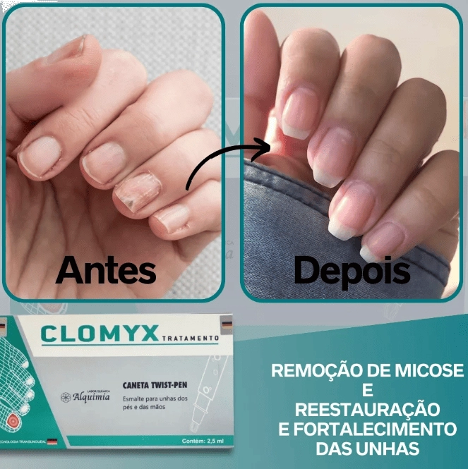 Clomyx, Tratamento Fortalecedor de Unhas contra Fungos e Micose, Tecnologia Alemã 2,5ml, Alquimia