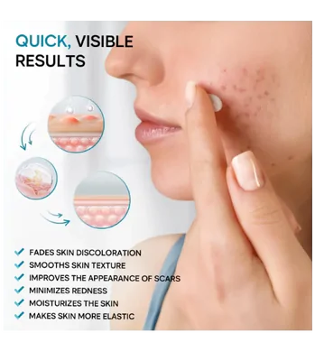 Scar Cream, Creme para Remoção de Cicatrizes, 55ml, Remedial Pax