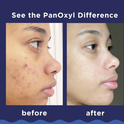 Sabonete Antiacne + Peróxido de Benzoíla 10%, 85g, PanOxyl