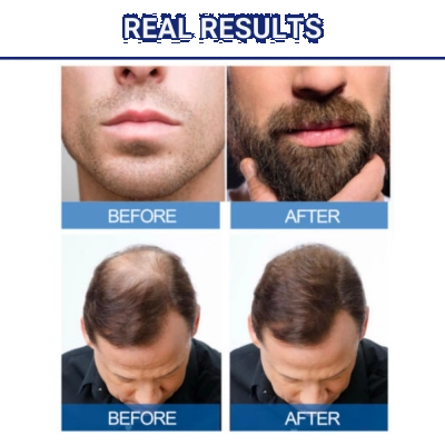 Minoxidil, Tratamento Capilar 3 Unidades + Dosador, (Barba e Cabelo), 60ml, Kirkland