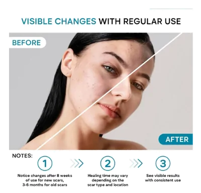 Scar Cream, Creme para Remoção de Cicatrizes, 55ml, Remedial Pax