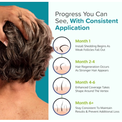  Espuma de Minoxidil 5% para Homens, Estimula o Crescimento Capilar, 60g, C'rcle