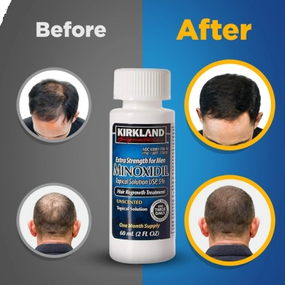 Minoxidil, Tratamento Capilar 3 Unidades + Dosador, (Barba e Cabelo), 60ml, Kirkland