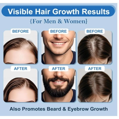 Minoxidil 5% para Crescimento Capilar Masculino e Barba, Kit 4 Meses, 60g Cada, ERYLVEKA