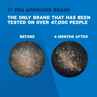 Rogaine Extra Strength, Masculino, 5% solução de minoxidil, 60ml Unidade