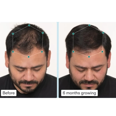 Suplemento Capilar Masculino, Crescimento de Cabelos Grossos e Fortes,  120 cápsulas, Nutrafol