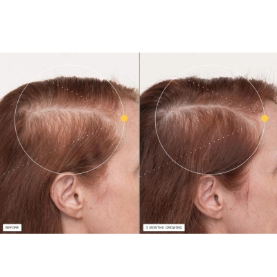 Suplemento Capilar,  Pós-Menopausa, Crescimento de Cabelos Grossos e Fortes, 120 cápsulas, Nutrafol