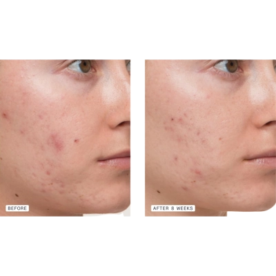 Suplemento Clear Skin Acne para Mulheres, 120 cápsulas, Nutrafol