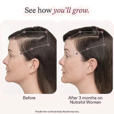 Suplemento Para Cabelos Femininos, Crescimento capilar e queda de cabelo, 120 cápsulas, Nutrafol