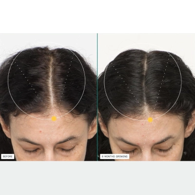 Suplemento Para Cabelos Femininos, Crescimento capilar e queda de cabelo, 120 cápsulas, Nutrafol